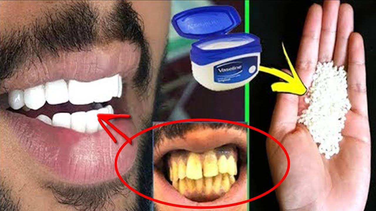 Зубы желтый чистить. Желтые зубы отбеливание. Отбелить зубы в домашних. Отбеливание зубов в домашних условиях. Отбеливание зубов домашнее отбеливание.